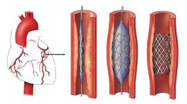 coronary-angioplasty-moradabad