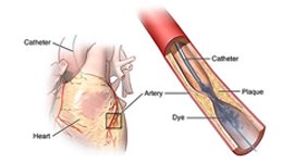 coronary-angiography-moradabad
